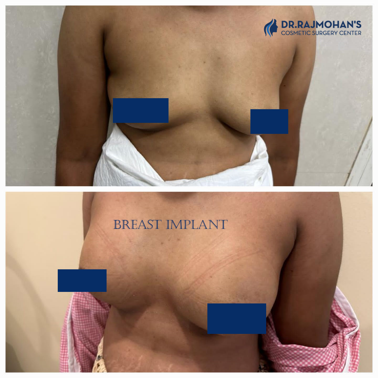 Breast implant Surgery cost in chennai